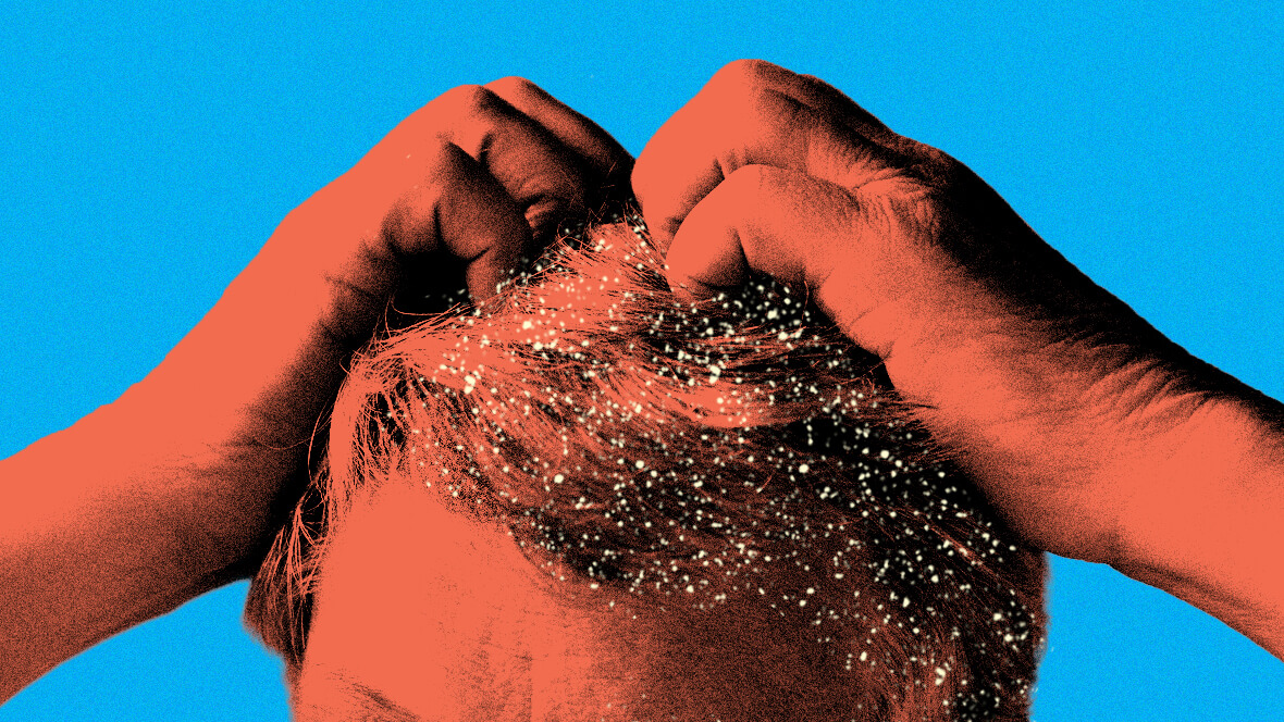 how to get rid of dandruff