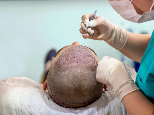What Are The Key Reasons For Hair Loss In Men Under 25? 8 Treatment and prevention options for hair loss for men in 20s