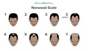 Receding Hairline In Men: Causes And Treatment Options 2 Receding hairline stages
