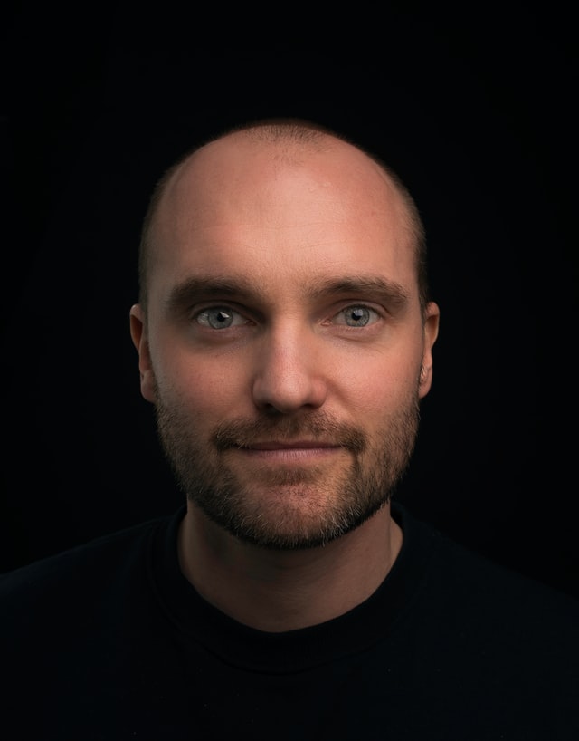 Early Warning Signs Of Receding Hairline: What To Look Out For? 2 alopecia totalis