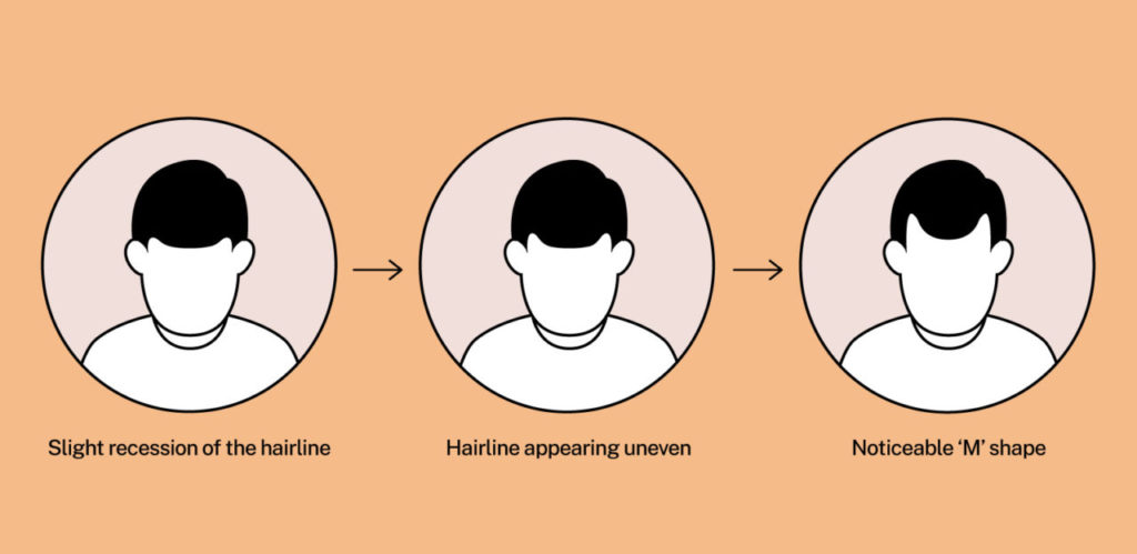 Common Hair Loss (Alopecia) Questions Answered 2 Sons May Blog HL Post Images 1