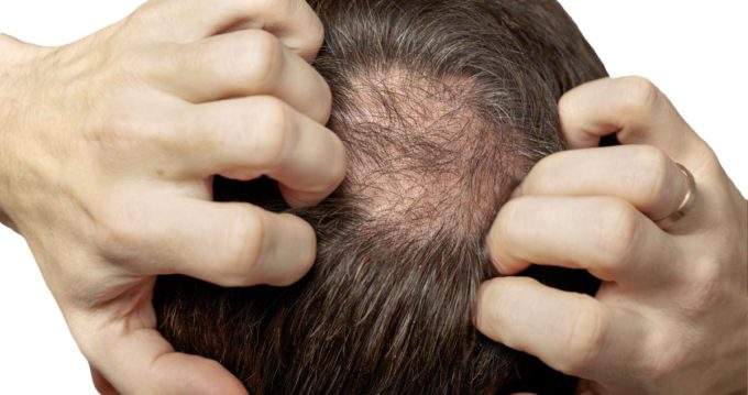 Hair Loss vs. Hair Thinning: Know the Difference 5 hair loss vs hair thinning