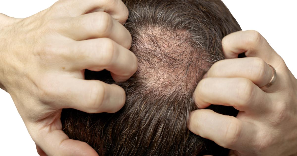 hair loss vs hair thinning