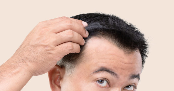 10 Surprising Facts About Hair Loss in Men 4 hair loss