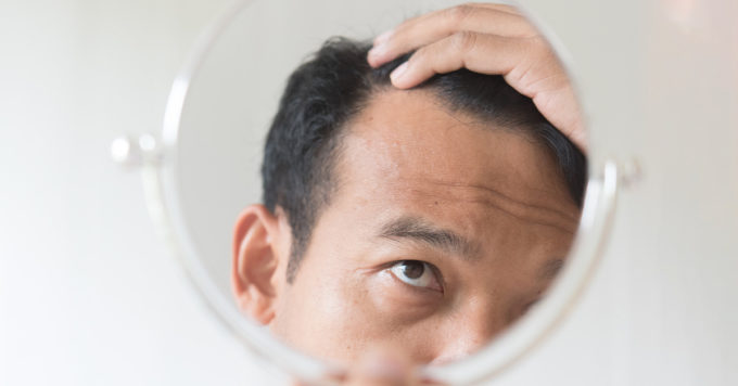 DHT and Hair Loss: Everything You Need to Know 2 dht & hair loss