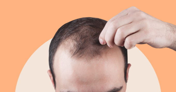 Telogen Effluvium: Symptoms, Causes, and Treatments 1 Telogen Effluvium