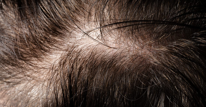 Traction Alopecia: Symptoms, Causes, and Treatments 9 Traction Alopecia