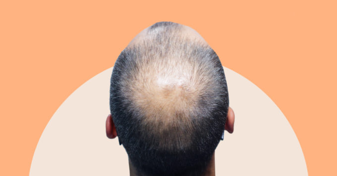 Androgenic Alopecia : Stages, Causes & Treatments 7 Androgenic Alopecia