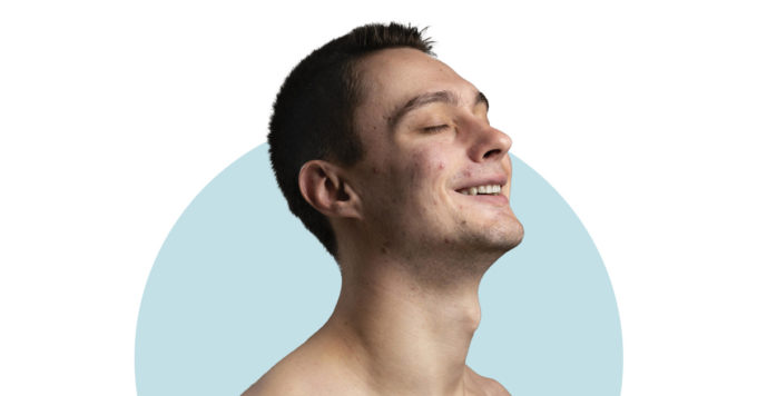 10 Common Myths About Acne 1 acne