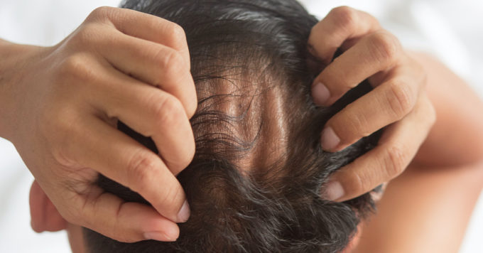 Androgenetic Alopecia: Causes and Treatments 2 Androgenetic Alopecia