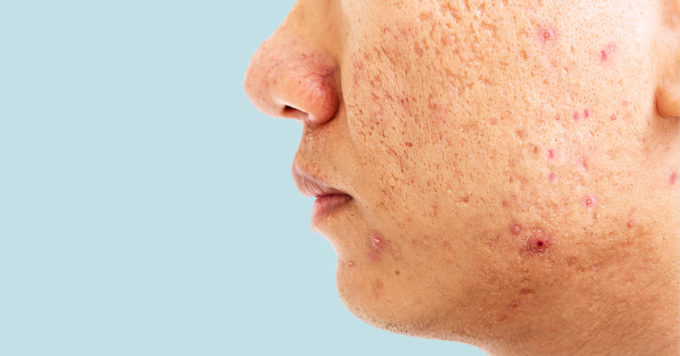 Acne Scars: Types, Causes and Treatment Options 10 Acne Scars