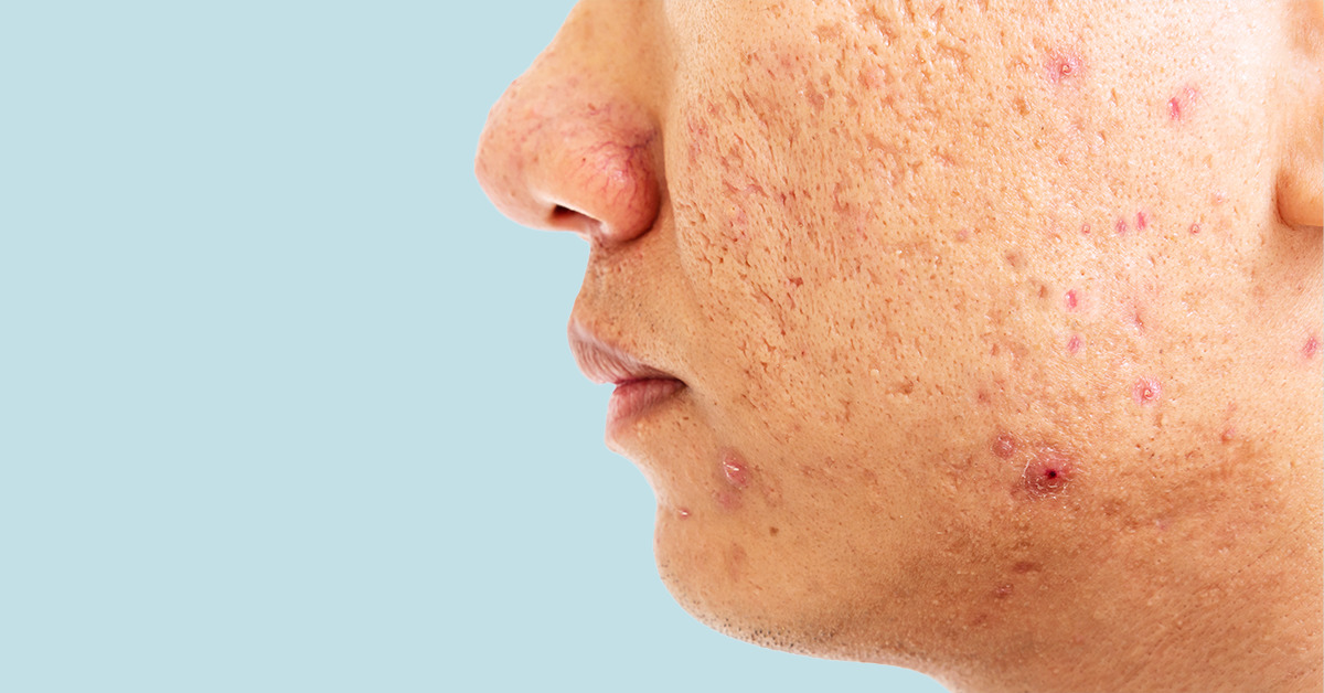 Acne Scars
