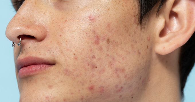 Acne vs Acne Scars: What’s the Difference? 4 acne