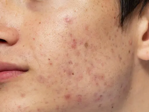 Acne-Prone Skin