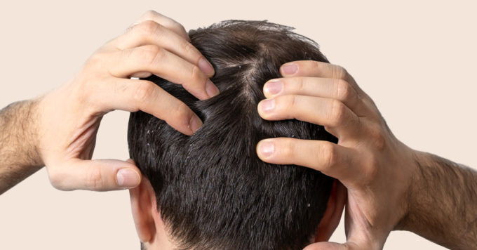 How Does Dandruff Cause Hair Loss: Myth or Fact 7 Dandruff Cause Hair Loss
