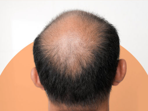 Alopecia Areata
