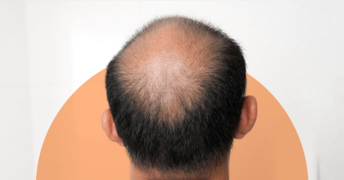 Alopecia Areata (Hair Loss): Symptoms, Causes, and Treatment 3 Alopecia Areata