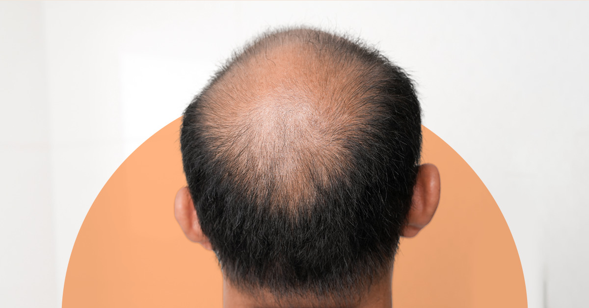Alopecia Areata