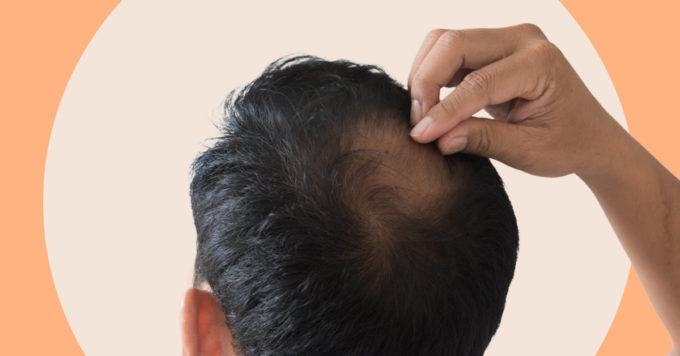 Male Pattern Baldness – Causes and Treatment Options 5 male pattern baldness
