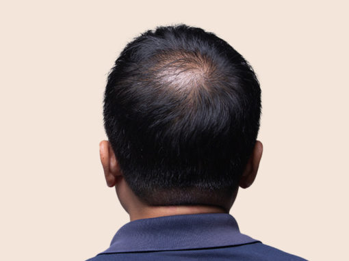 Dry Scalp