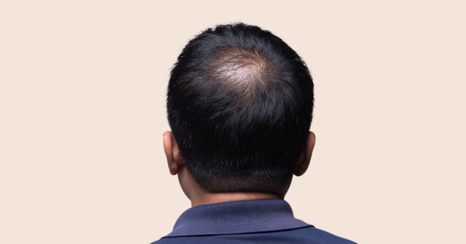 Alopecia Types: Understanding the Different Forms of Hair Loss 4 Alopecia Types